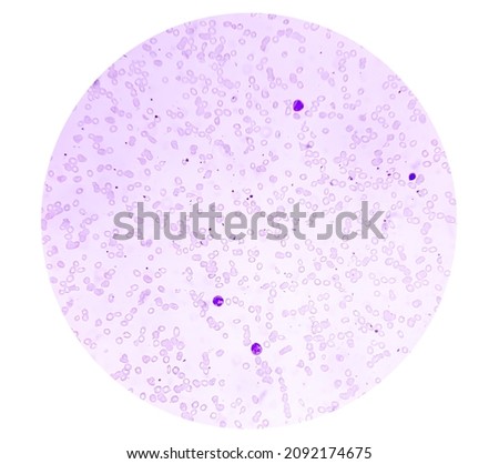 Macrocytic anemia with features of hemolysis and nucleated RBC analyzed by microscope.  Royalty-Free Stock Photo #2092174675