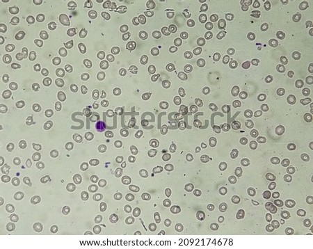 Macrocytic anemia with features of hemolysis and nucleated RBC analyzed by microscope.  Royalty-Free Stock Photo #2092174678