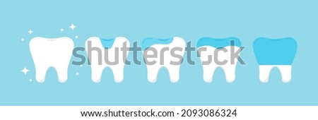 Tooth dental inlay, onlay, overlay and crown treatment set. Teeth dentistry restoration with ceramic porcelain sealant in cavity. Vector flat design cartoon clip art illustration.