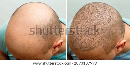 The head of a balding man before and after hair transplant surgery. A man losing his hair has become shaggy. An advertising poster for a hair transplant clinic. Treatment of baldness. Royalty-Free Stock Photo #2093137999