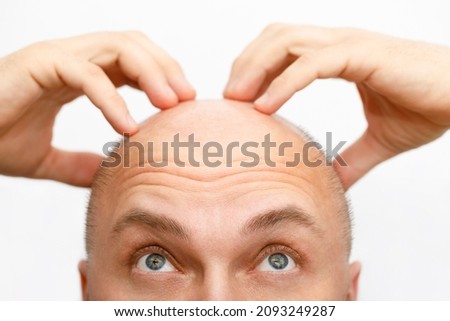 The head of a balding man. A bald man was upset because of the hair loss. Treatment of baldness. Royalty-Free Stock Photo #2093249287
