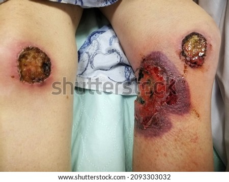 Contact dermatitis with ulcerations, necrosis and streptococcal cellulitis Royalty-Free Stock Photo #2093303032