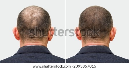 The head of a balding man before and after hair transplant surgery. A man losing his hair has become shaggy. An advertising poster for a hair transplant clinic. Treatment of baldness. Royalty-Free Stock Photo #2093857015