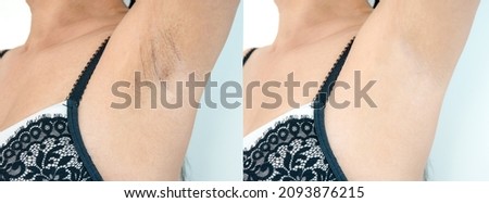 Close up underarm chicken skin problem in Asian woman armpit, Fox Fordyce, black armpit in woman. Before and after skincare cosmetology armpits epilation treatment concept. 