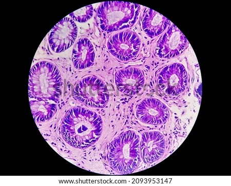 Photomicrograph of Rectal cancer. Microscopic slide view. IBD. IBS. Royalty-Free Stock Photo #2093953147