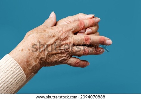 A senior woman massages her fingers, experiencing pain in the joints. The diseased joints are highlighted in red. Blue background, hands close-up. The concept of rheumatism and arthritis. Royalty-Free Stock Photo #2094070888