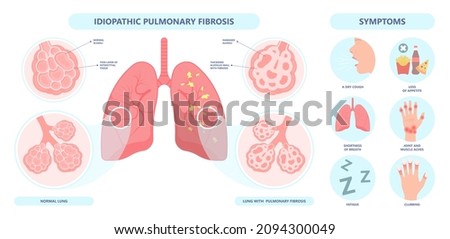 Capillary dry cough of wood metal dust breath virus Chest X-ray Cancer scan High resolution HRCT Biopsy usual COPD chronic asbestos corona covid 19 cystic diagnose disorder dyspnea fibers ILD UIP IPF Royalty-Free Stock Photo #2094300049