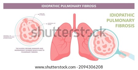 Capillary dry cough of wood metal dust breath virus Chest X-ray Cancer scan High resolution HRCT Biopsy usual COPD chronic asbestos corona covid 19 cystic diagnose disorder dyspnea fibers ILD UIP IPF Royalty-Free Stock Photo #2094306208