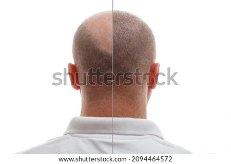 The head of a balding man before and after hair transplant surgery. A man losing his hair has become shaggy. An advertising poster for a hair transplant clinic. Treatment of baldness. Royalty-Free Stock Photo #2094464572