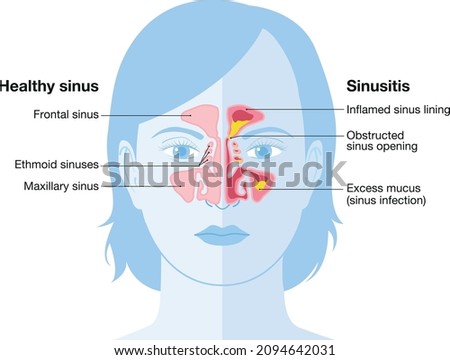 Vector illustration showing healthy sinus and sinusitis with inflamed lining, obstructed sinus opening, adenoid and excess mucus Royalty-Free Stock Photo #2094642031