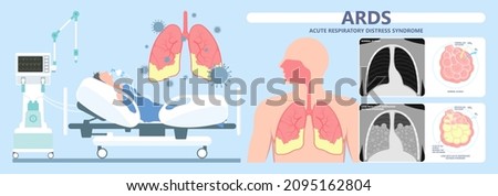 Acute respiratory distress syndrome (ARDS) a respiratory failure and inflammation in the lungs equipment hospital Emphysema fibrosis idiopathic Cystic Collapsed pneumothorax embolism X-Ray chest ICU Royalty-Free Stock Photo #2095162804