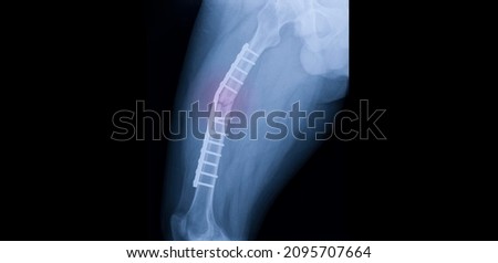 A hip and thigh x-ray showing closed fracture at shaft of right femur. The patient has fixation with plate and screws. The image shows implant failure or broken plate at the fracture site. Royalty-Free Stock Photo #2095707664