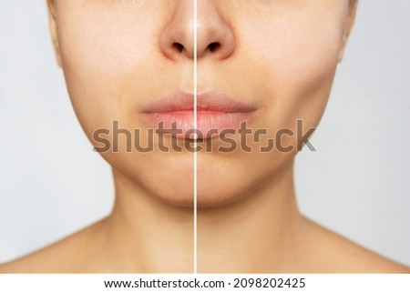Cropped shot of young caucasian woman before and after plastic surgery buccal fat pad removal on a white background. A lower part of face with clear highlighted cheekbones. Result of cosmetic surgery Royalty-Free Stock Photo #2098202425