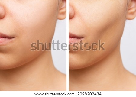 Cropped shot of young caucasian woman before and after plastic surgery buccal fat pad removal on a white background. Result of cosmetic surgery. Cosmetology concept Royalty-Free Stock Photo #2098202434