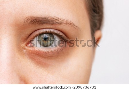 Cropped shot of a young caucasian woman's face with dark circle under eye isolated on a white background. Bruise under the eyes are caused by fatigue, nervousness, lack of sleep, insomnia and stress