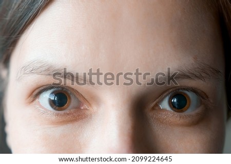 Close-up of a woman's brown eyes with dilated big pupils. Eye drops after a visit to an ophthalmologist. Concept of healthy vision. Ophthalmological examination and treatment. Royalty-Free Stock Photo #2099224645