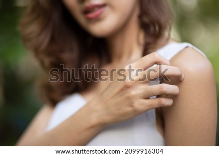Asian woman scratching her arm skin, concept of dry skin, allergic dermis inflammation, fungus infection, dermatology disease, eczema, rash, skin care Royalty-Free Stock Photo #2099916304