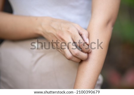 Asian woman scratching her arm skin, concept of dry skin, allergic dermis inflammation, fungus infection, dermatology disease, eczema, rash, skin care Royalty-Free Stock Photo #2100390679