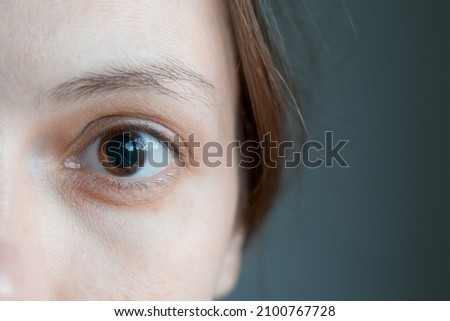 Close-up of a woman's brown eye with dilated big pupil. Eye drops after a visit to an ophthalmologist. Concept of healthy vision. Ophthalmological examination and treatment. Royalty-Free Stock Photo #2100767728