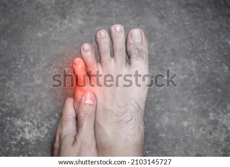 Painful little toe of Asian young man. Caused by stubbed toe, broken toe, ingrown toenail, bunions, corns or ill fitting shoes. Royalty-Free Stock Photo #2103145727