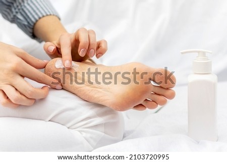 Womans hand applies moisturizing nourishing cream to the heels of feet with dry cracked skin while sitting on a white bed. Home foot care and treatment for dermatitis, eczema, dryness. Royalty-Free Stock Photo #2103720995