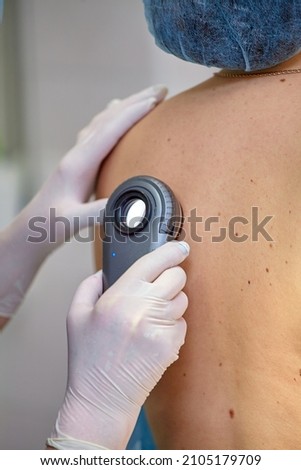 Dermatoscopy-a method of research and diagnosis of skin tumors - moles, birthmarks, nevi, warts, acne with a special optical device Dermatoscope. Prevention of melanoma, skin cancer. Royalty-Free Stock Photo #2105179709
