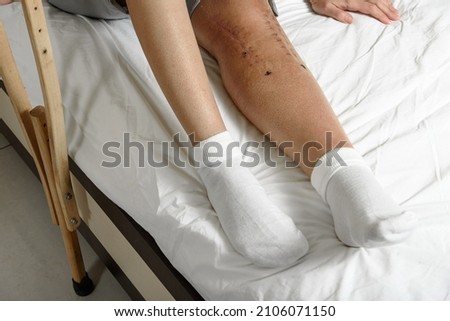 Female patient with postoperative suture after surgery on broken leg sitting on bed. Woman with knee fracture holding crutch. Concept of rehabilitation after serious limb fractures and injuries Royalty-Free Stock Photo #2106071150