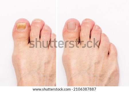 Macro shot of a male foot with yellow ugly fungus on toenails and healthy nails before and after treatmet isolated on a white background. Fungal nail infection. Advanced stage of disease. Top view Royalty-Free Stock Photo #2106387887