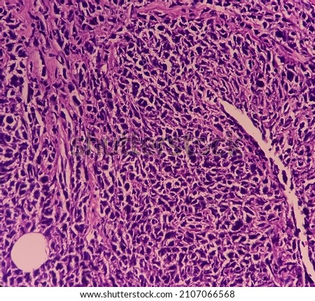 Microscopic image of Colorectal carcinoma and Amelanotic melanoma. Show malignant neoplasm, atypical squamous epithelial cells and areas of necrosis are noted. Royalty-Free Stock Photo #2107066568