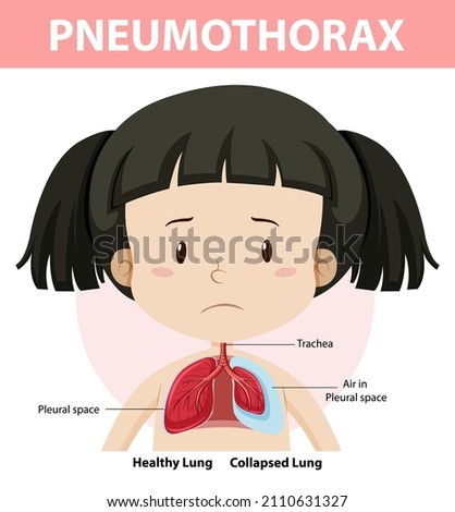 Pneumothorax diagram of human anatomy illustration