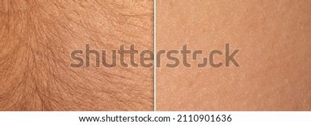 Macro of a woman's skin before and after an epilation treatment. Difference and comparison between skin with and without long hair. Permanent laser hair removal Royalty-Free Stock Photo #2110901636