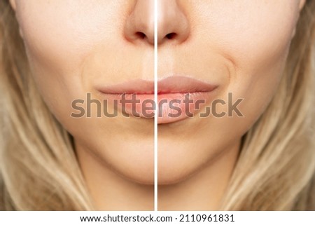 Cropped shot of young caucasian blonde woman's face with lips before and after lip enhancement. Injection of filler in lips. Lip augmentation. Close up Royalty-Free Stock Photo #2110961831