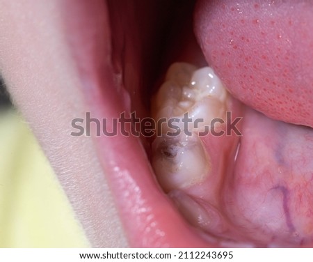 Caries on a baby's tooth, close-up. Concept of dental treatment for children in modern dentistry, macro Royalty-Free Stock Photo #2112243695
