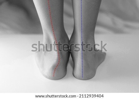 Boy's feet with flat feet or fallen arch, ankle lean inward causing leg length difference. The red line showing abnormal shapes flat foot compare to normal foot. Royalty-Free Stock Photo #2112939404