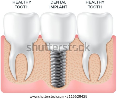 Human jaw with normal teeth and dental implant vector illustration. Tooth after dental procedure. Surgical implant in oral cavity. Treatment, dentistry, oral health care. Healthy tooth in human gum