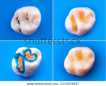 tooth restoratin by esthetic composite filling befor e and after picture Royalty-Free Stock Photo #2115924047