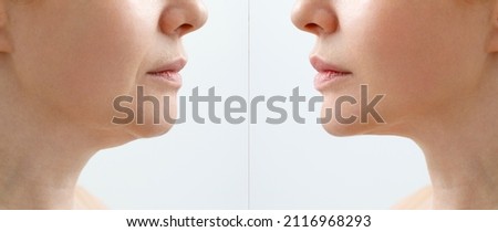 A close portrait of an aged woman before and after facial rejuvenation procedure. Correction of the chin shape liposuction of the neck. The result of the procedure in the clinic of aesthetic medicine. Royalty-Free Stock Photo #2116968293