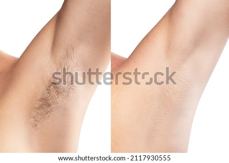 Comparison of female armpit after hair removal treatment Royalty-Free Stock Photo #2117930555