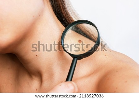 Close-up of a big mole on a young woman's neck magnified with a magnifying glass isolated on a gray background. The effect of sunlight on the skin Royalty-Free Stock Photo #2118527036