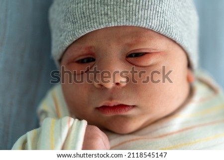 Awake Newborn Baby Face Portrait Acne Allergic Irritations Early Days Grimace Crying On Blue Background. Child Start Minutes Of Life. Infants, Childbirth, First Moments Of Borning, Beginning Concept.
