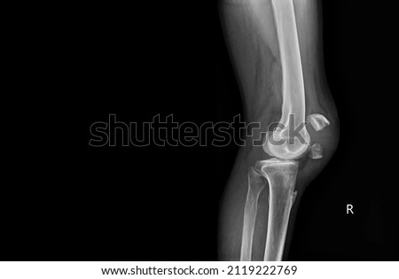 A film x-ray of left knee lateral view shown fracture of knee cap(patella) bone. The plain film on dark background with copy space.Medical concept. Royalty-Free Stock Photo #2119222769