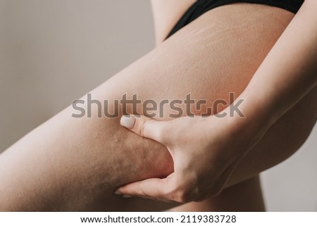 cellulite on the skin close up Royalty-Free Stock Photo #2119383728