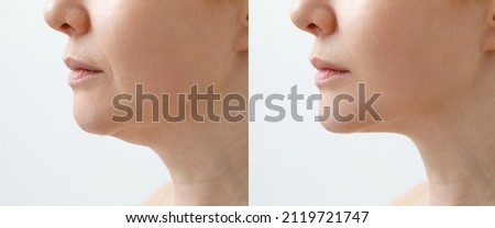 A close portrait of an aged woman before and after facial rejuvenation procedure. Correction of the chin shape liposuction of the neck. The result of the procedure in the clinic of aesthetic medicine. Royalty-Free Stock Photo #2119721747
