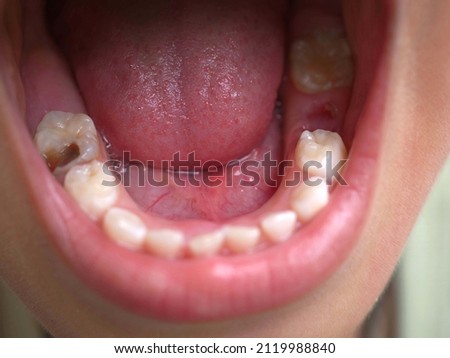 Child patient open mouth showing caries teeth decay. closeup photo, blurred. Royalty-Free Stock Photo #2119988840
