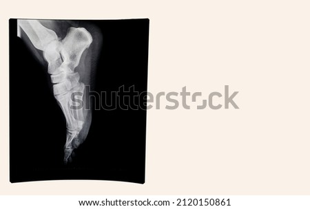 lateral x-ray of a foot of a young man