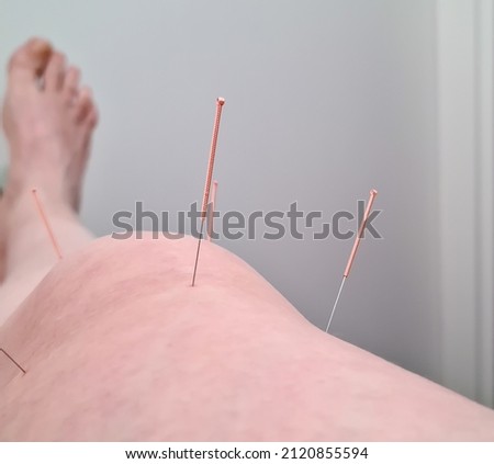 Therapy of female knee with pricking acupuncture needles. close-up. Real photo. Selective focus on the needle.