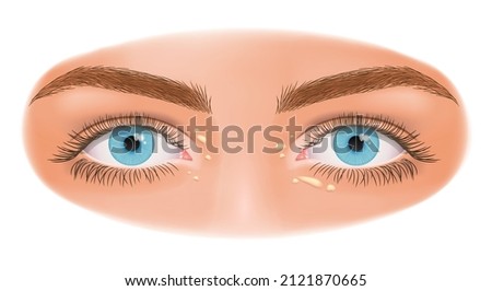 Xanthelasma. Flattened benign neoplasm. Close up of woman eyes with Xanthelasma on the eyelids. Sign of high cholesterol. Dermatology. Royalty-Free Stock Photo #2121870665