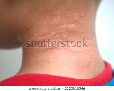 Asian kid's throat rash is caused by urticaria, food allergies, insect bites. health concept. closeup photo, blurred. Royalty-Free Stock Photo #2123515346