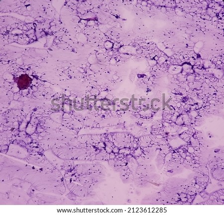 Breast lump(biopsy): Fat necrosis, injury of fatty tissue, show fragments of fatty tissue, foamy histiocytes, giant cells and inflammatory cells, benign condition. Royalty-Free Stock Photo #2123612285