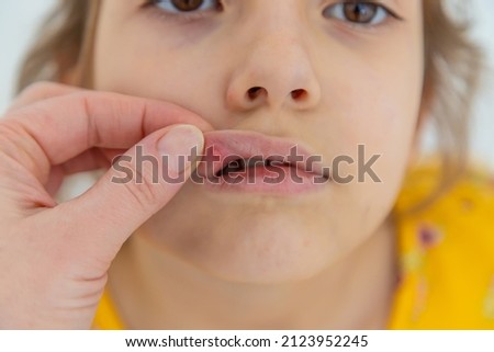 The child has stomatitis on the lip. Selective focus. Kid. Royalty-Free Stock Photo #2123952245